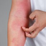 Atopowe zapalenie skóry – przyczyny, objawy, leczenie
